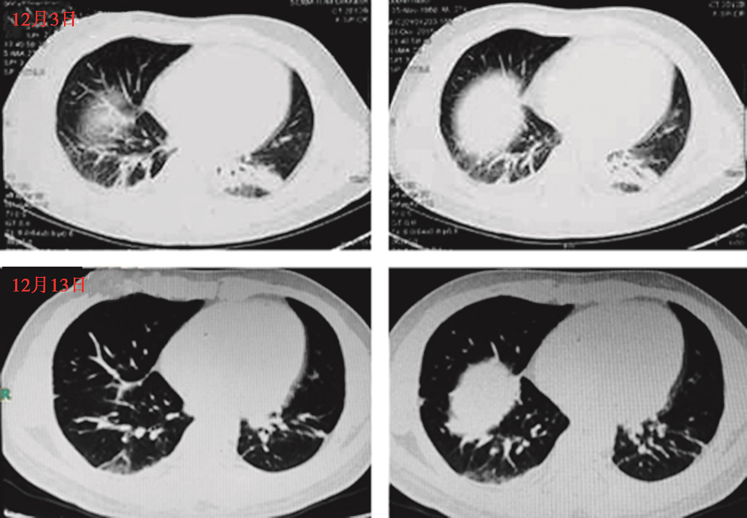图5 肺部CT（12月13日）.jpg